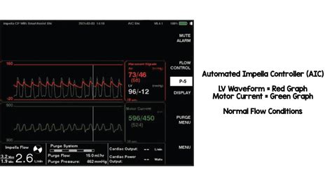 lv waveform|impella numbers explained.